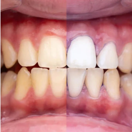 Branqueador dental V34