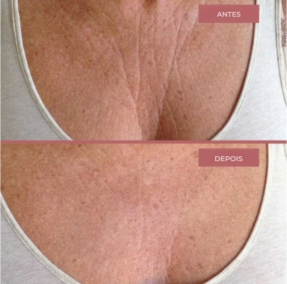 Patches de biocolágeno para o peito