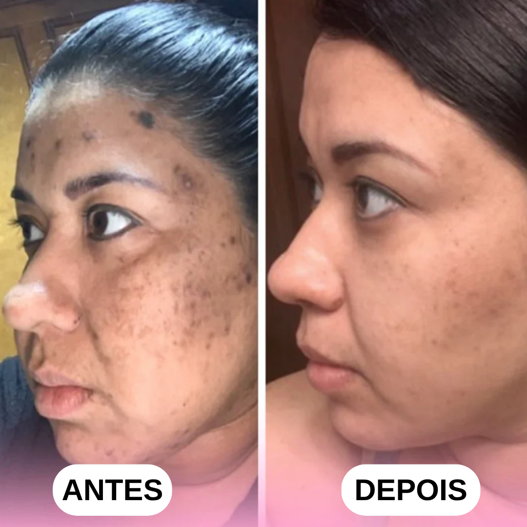 Discos de Cúrcuma e Ácido Kójico