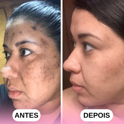 Discos de Cúrcuma e Ácido Kójico