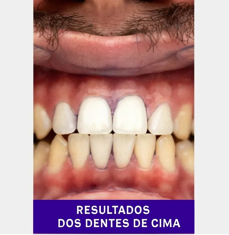 Tiras Branqueadoras V34