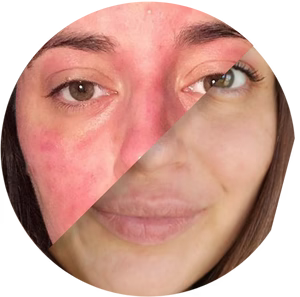 files/AD-COMPOSITE-Miracle-Eczema-Cream-V2_1.avif