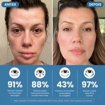 Óculos anti bolsas e olhos